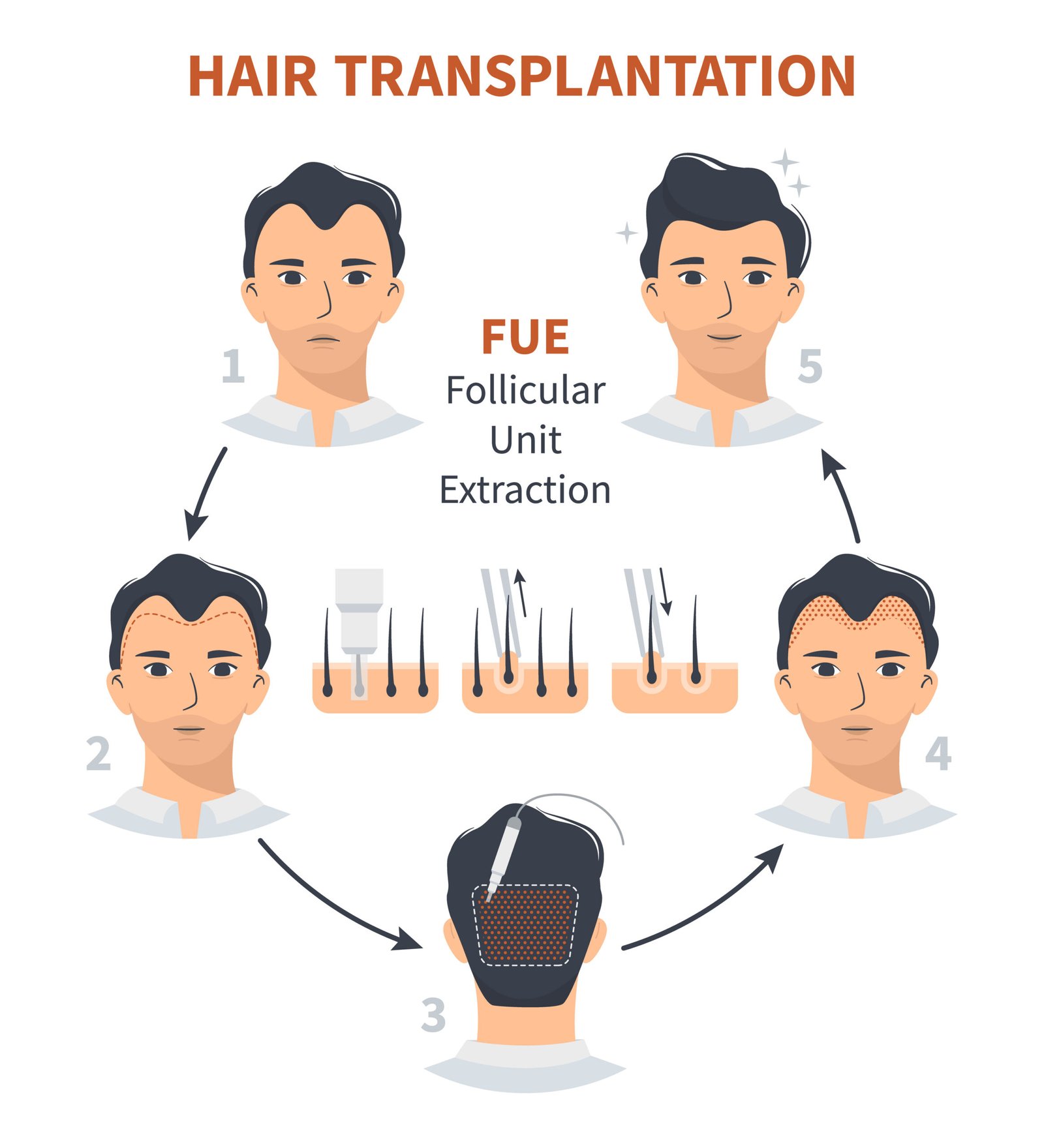 hair transplant